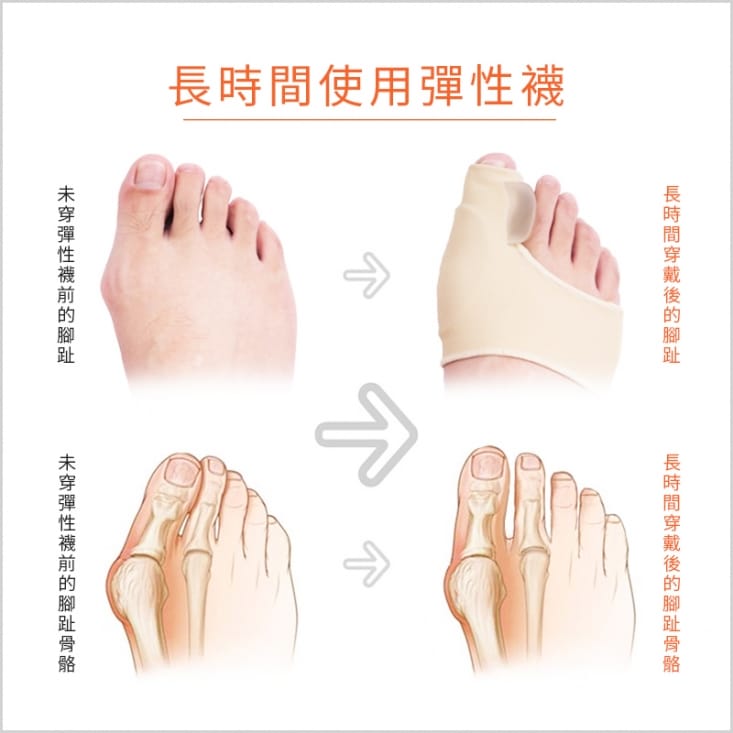 【足的美形】升級版萊卡矽膠拇趾外翻分趾套