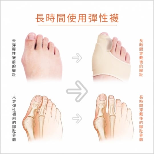 【足的美形】升級版萊卡矽膠拇趾外翻分趾套