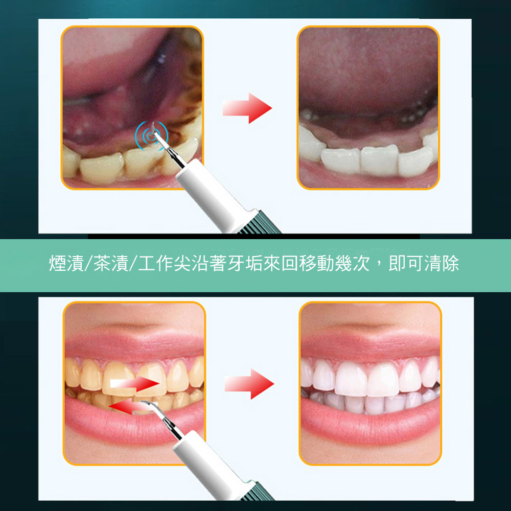 智能超聲波牙結石去除器洗牙機